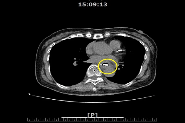 Hình ảnh CT của cụ bà họ Thái cho thấy có vật thể lạ trong thực quản, được khoanh tròn màu vàng, là viên thuốc còn bọc trong giấy bạc. (Ảnh: Trích từ udn.com)